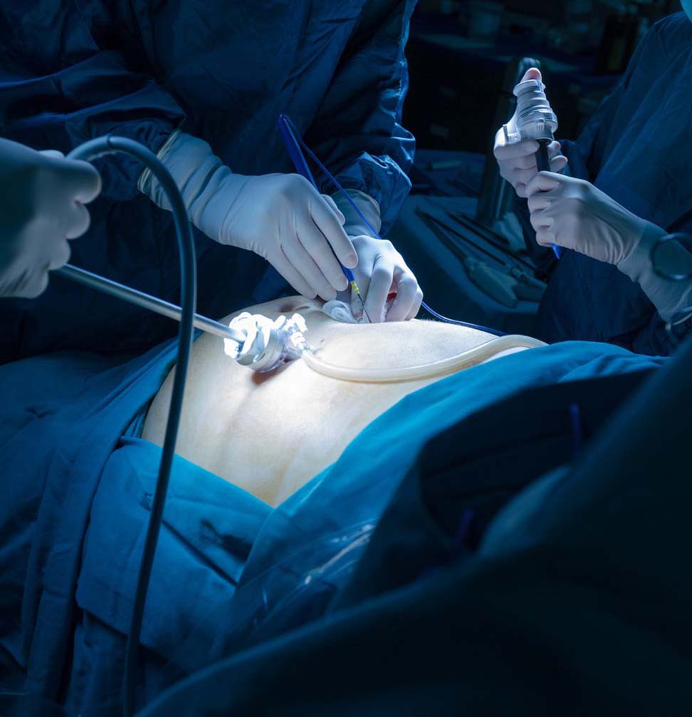 Reusable laparoscopic instruments in Thrissur india